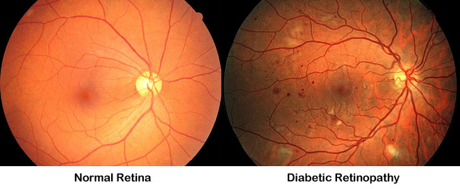 vision loss normal lens normal retina