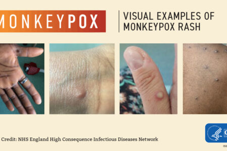 Monkeypox In The News